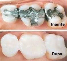 Tratamentul cariei simple (plomba)