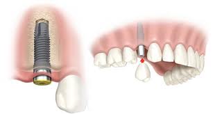 Implantul dentar