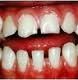 Afecțiunile gingiilor la copii