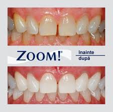 Cosmetică dentară: albire și fațete