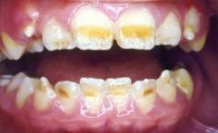 Anomalii dentare de formă, structură și mărime