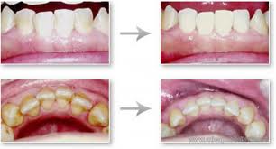 Parodontologie: tratamentul gingiilor