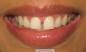 Strungăreața (diastema interincisivă)