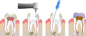 Endodonția: tratamentul de canal