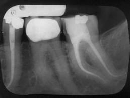 Endodonția: tratamentul de canal
