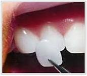 Cosmetică dentară: albire și fațete