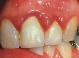 Afecțiunile gingiilor la copii