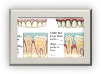 Afecțiunile gingiilor la copii