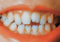 Anomalii dentare de formă, structură și mărime