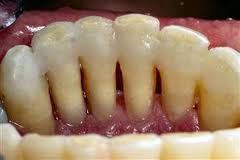 Parodontologie: tratamentul gingiilor