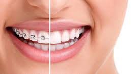 Aparatul dentar fix metalic