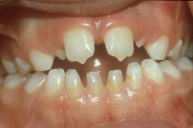 Anomalii dentare de formă, structură și mărime