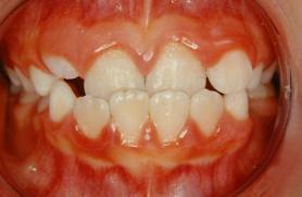Prognatismul mandibular funcțional