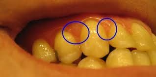 Afecțiunile gingiilor la copii