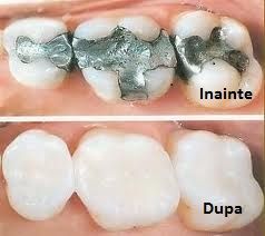 Terapia odontală: tratarea cariilor