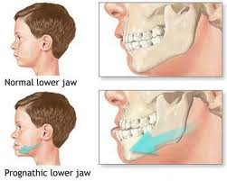 Prognatismul mandibular anatomic