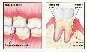 Parodontologie: tratamentul gingiilor